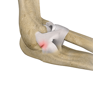 Lateral Ulnar Collateral Ligament Injuries