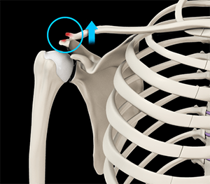 AC Joint Dislocation