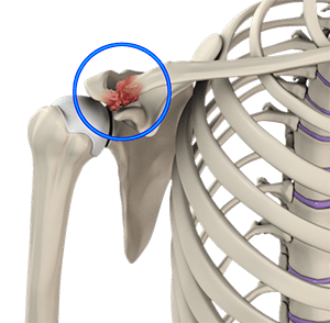 Acromioclavicular Joint Osteoarthritis Orlando, FL