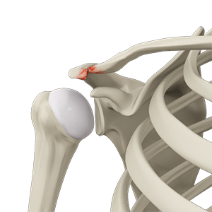 Acromioclavicular Arthritis