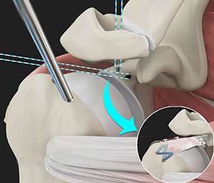 Arthroscopic Superior Capsular Reconstruction