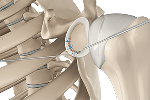  Arthroscopic Bankart Repair