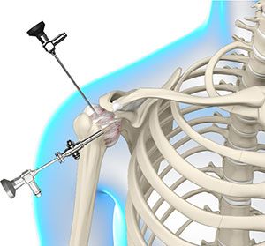 Arthroscopic Frozen Shoulder Release 