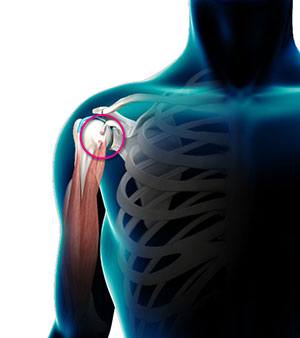 Biceps Tendon Rupture