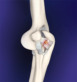 Elbow Ligament Injuries