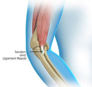 Elbow Tendon and Ligament Repair