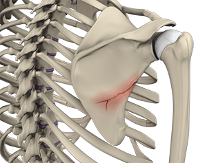 Fracture of the Shoulder Blade