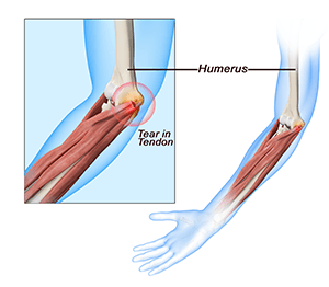 Golfer’s Elbow