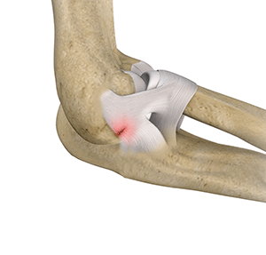 Lateral Ulnar Collateral Ligament Injuries Orlando, FL | Ligament ...