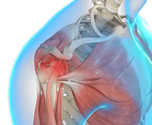 Partial Rotator Cuff Tears Fountain Valley  Shoulder Pain San Juan  Capistrano, San Clemente