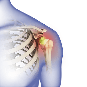 Shoulder Dislocation