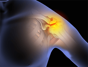 Shoulder Impingement