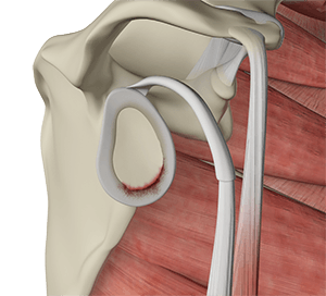 Shoulder Labral Tear