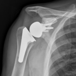 Reverse Shoulder Replacement: Why did my surgeon place my shoulder replacement backwards?